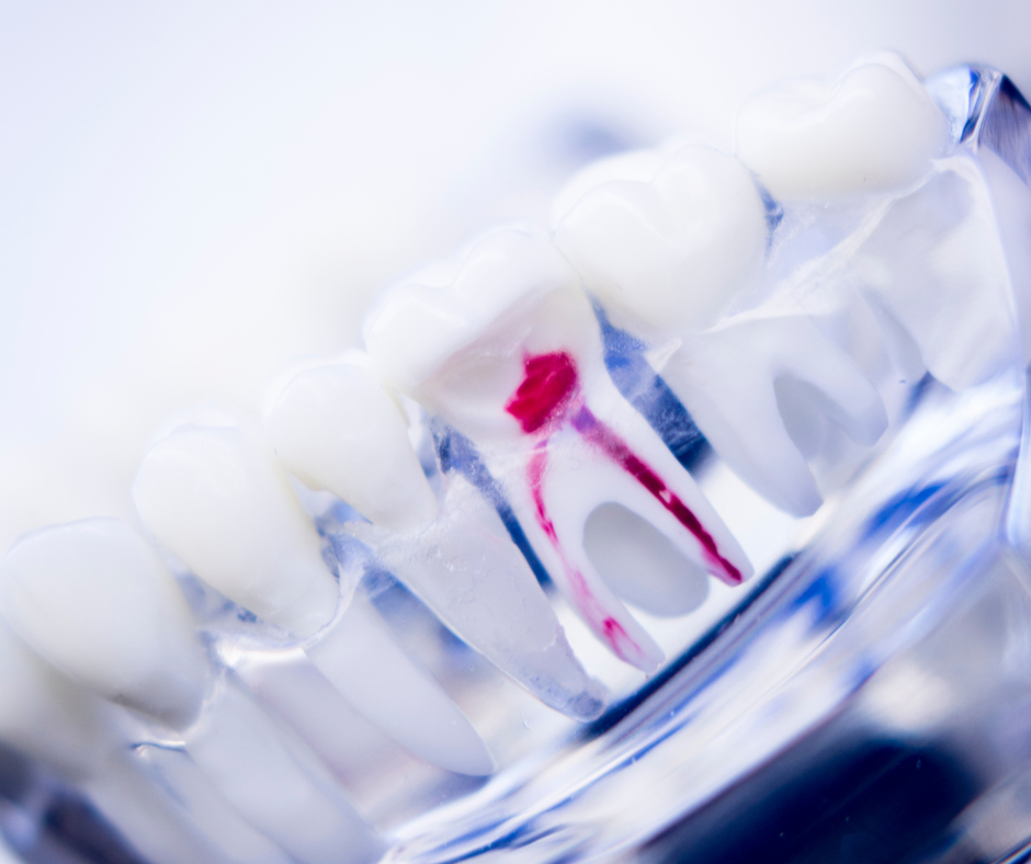Dental Implants Rexburg